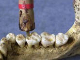 Свинец в зубах может рассказать историю тела
