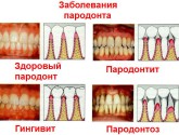 Лечение заболеваний тканей пародонта