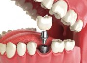 Своевременное протезирование зубов поможет решить многие проблемы