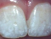 Некроз твердых тканей зубов: методы лечения