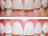 Восстановление зубов в кратчайшие сроки: возможно ли это?