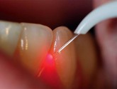 Уменьшить боль у ортодонтических пациентов поможет лазерная терапия
