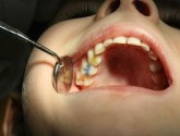 Как нарастить передний зуб