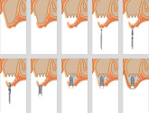Шаг за шагом: что происходит в ходе стоматологической процедуры имплантации