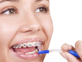 Исправление кривых зубов и прикуса