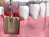 Для чего ставится зубной имплантат