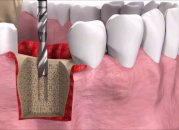 Для чего ставится зубной имплантат