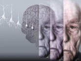 Болезнь Альцгеймера: насколько приговор окончателен?