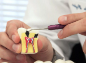 Эндодонтия: лечим каналы зубов