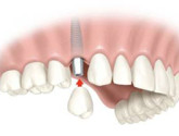Современные методики имплантации зубов