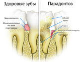 Витамины и заболевания тканей пародонта